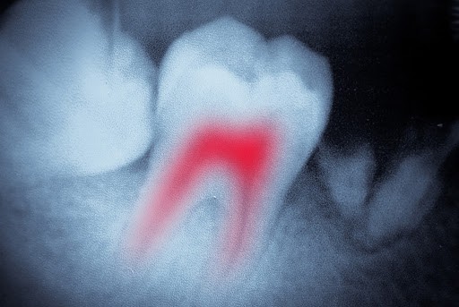 AVFC X-ray tooth