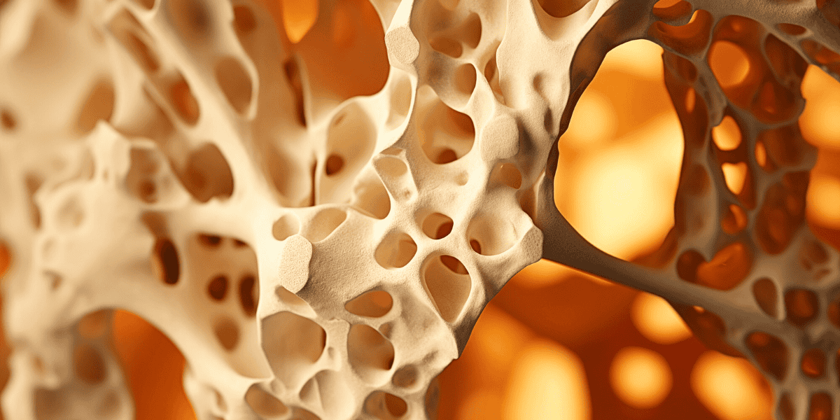 Osteoporosis diagnosis