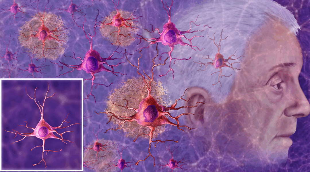 Type 3 Diabetes and the Brain: A Metabolic Story Unfolding