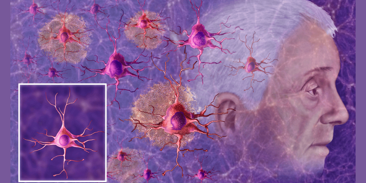 is Type 3 Diabetes the same as alzheimer's?