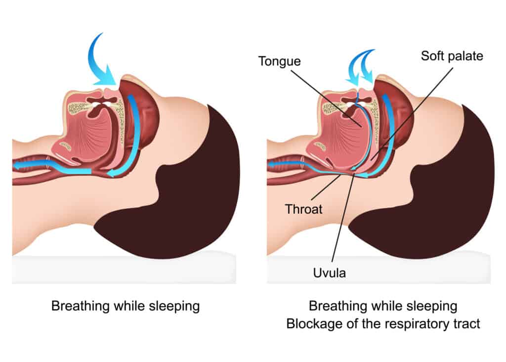 how can myofunctional therapy help with snoring?